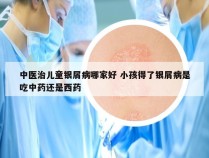 中医治儿童银屑病哪家好 小孩得了银屑病是吃中药还是西药