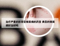 治疗严重的形常型银屑病的药膏 典型的银屑病好治好吗