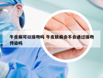 牛皮癣可以接吻吗 牛皮肤癣会不会通过接吻传染吗