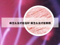 癣怎么治才能治好 癣怎么治才能断根