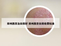 郑州西京治白斑好 郑州西京白斑收费标准