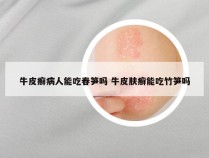 牛皮癣病人能吃春笋吗 牛皮肤癣能吃竹笋吗