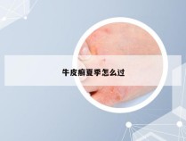 牛皮癣夏季怎么过