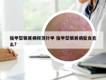 指甲型银屑病和顶针甲 指甲型银屑病能自愈么?