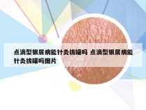 点滴型银屑病能针灸拔罐吗 点滴型银屑病能针灸拔罐吗图片