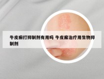 牛皮癣打抑制剂有用吗 牛皮廨治疗用生物抑制剂