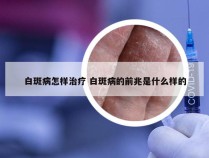 白斑病怎样治疗 白斑病的前兆是什么样的