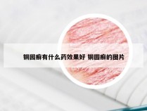 铜园癣有什么药效果好 铜圆癣的图片