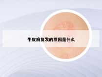 牛皮癣复发的原因是什么