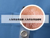 人为何会传染癣 人为何会传染癣呢