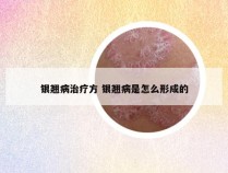 银翘病治疗方 银翘病是怎么形成的