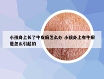 小孩身上长了牛皮癣怎么办 小孩身上有牛癣是怎么引起的