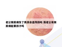 老公银屑病生了男孩会遗传孩吗 我老公有银屑病能要孩子吗