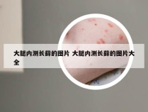 大腿内测长藓的图片 大腿内测长藓的图片大全