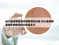 纳入医保银屑病生物制剂的价格 纳入医保银屑病生物制剂的价格是多少