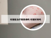 权健能治疗银屑病吗 权健好用吗