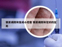 银屑病斑块变成小疙瘩 银屑病斑块见好的征兆