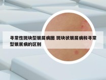 寻常性斑块型银屑病图 斑块状银屑病和寻常型银屑病的区别