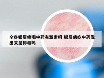 全身银屑病喝中药有激素吗 银屑病吃中药发出来是排毒吗