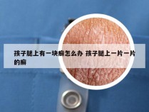 孩子腿上有一块癣怎么办 孩子腿上一片一片的癣