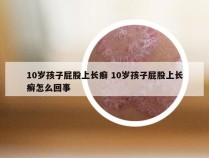 10岁孩子屁股上长癣 10岁孩子屁股上长癣怎么回事