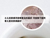 小儿皮肤病河南哪里治的最好 河南哪个医院看儿童皮肤病最好