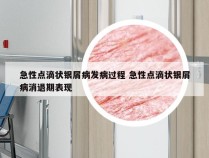 急性点滴状银屑病发病过程 急性点滴状银屑病消退期表现