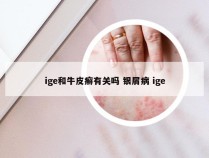 ige和牛皮癣有关吗 银屑病 ige