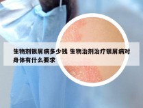 生物剂银屑病多少钱 生物治剂治疗银屑病对身体有什么要求