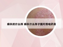 癣长的什么样 癣长什么样子图片擦啥药膏