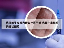 头顶的牛皮癣为什么一直不好 头顶牛皮肤癣的症状图片