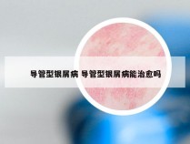 导管型银屑病 导管型银屑病能治愈吗