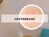 小孩子牛皮癣怎么治疗