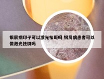 银屑病印子可以激光祛斑吗 银屑病患者可以做激光祛斑吗