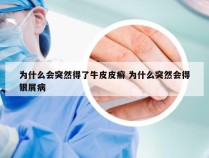 为什么会突然得了牛皮皮癣 为什么突然会得银屑病