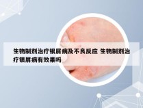 生物制剂治疗银屑病及不良反应 生物制剂治疗银屑病有效果吗