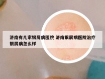 济南有几家银屑病医院 济南银屑病医院治疗银屑病怎么样