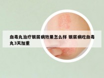 血毒丸治疗银屑病效果怎么样 银屑病吃血毒丸3天加重