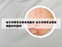 哈尔滨哪家治银屑病最好 哈尔滨哪家治银屑病最好的医院