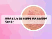 银屑病怎么治才能断根贴吧 银屑病治得好吗?怎么治?