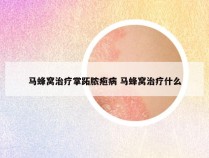 马蜂窝治疗掌跖脓疱病 马蜂窝治疗什么