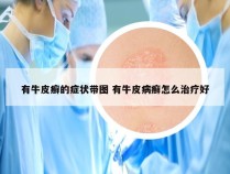 有牛皮癣的症状带图 有牛皮病癣怎么治疗好