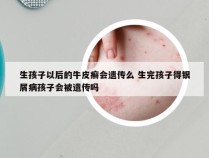 生孩子以后的牛皮癣会遗传么 生完孩子得银屑病孩子会被遗传吗