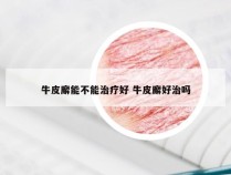 牛皮廨能不能治疗好 牛皮廨好治吗