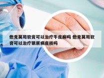 他克莫司软膏可以治疗牛皮癣吗 他克莫司软膏可以治疗银屑病皮损吗