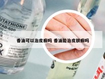 香油可以治皮癣吗 香油能治皮肤癣吗