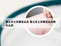 婴儿手上长癣怎么办 婴儿手上长癣怎么办用什么药