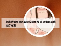 点滴状银屑病怎么能控制爆发 点滴状银屑病治疗方案