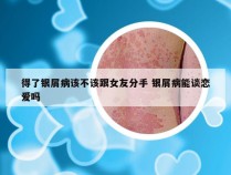 得了银屑病该不该跟女友分手 银屑病能谈恋爱吗