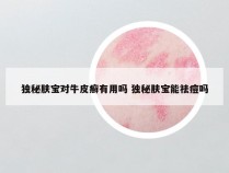 独秘肤宝对牛皮癣有用吗 独秘肤宝能祛痘吗